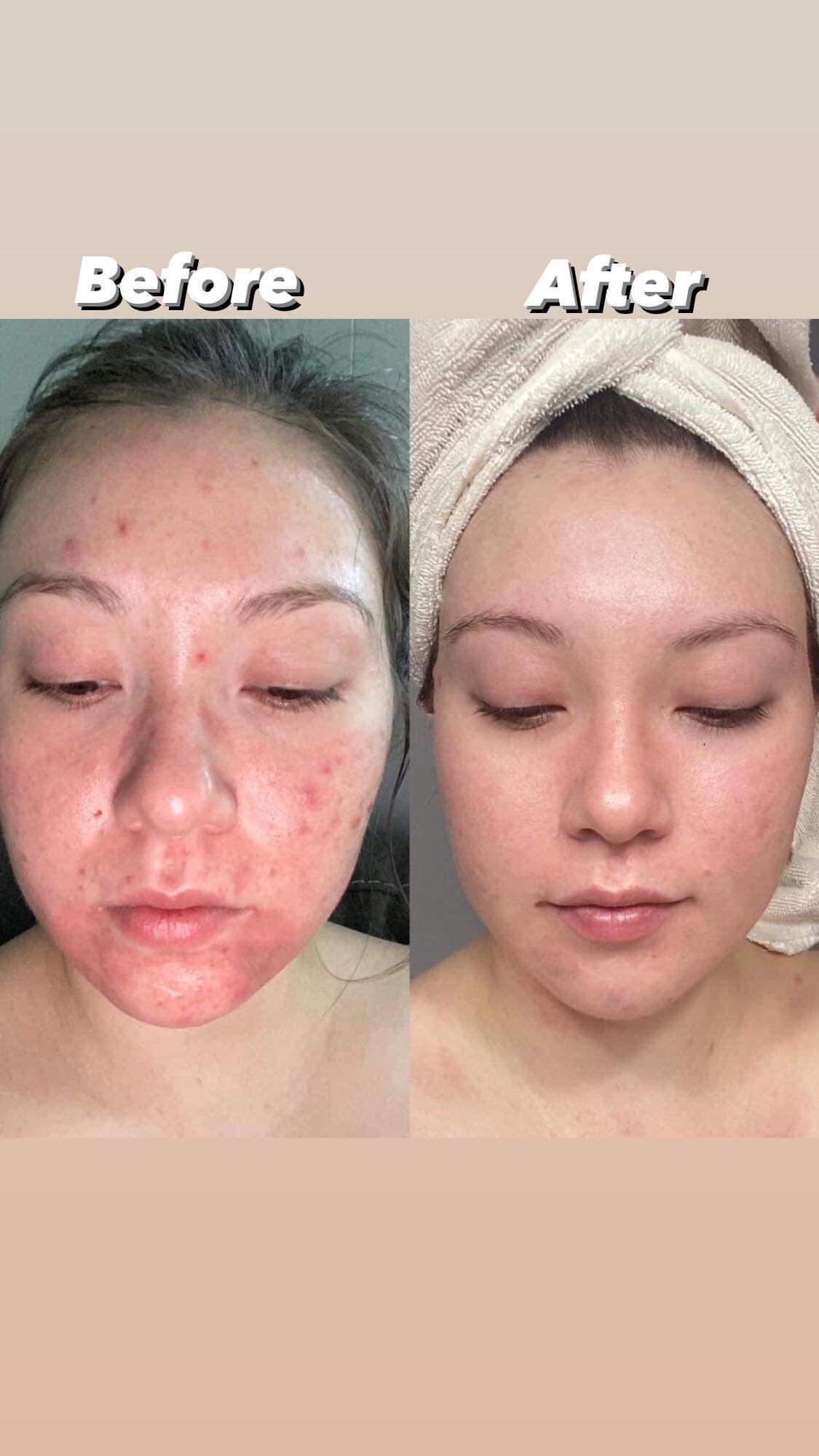 Vì Sao Bôi Nhiều Thuốc Mụn Nhưng Mụn Viêm Không Giảm?